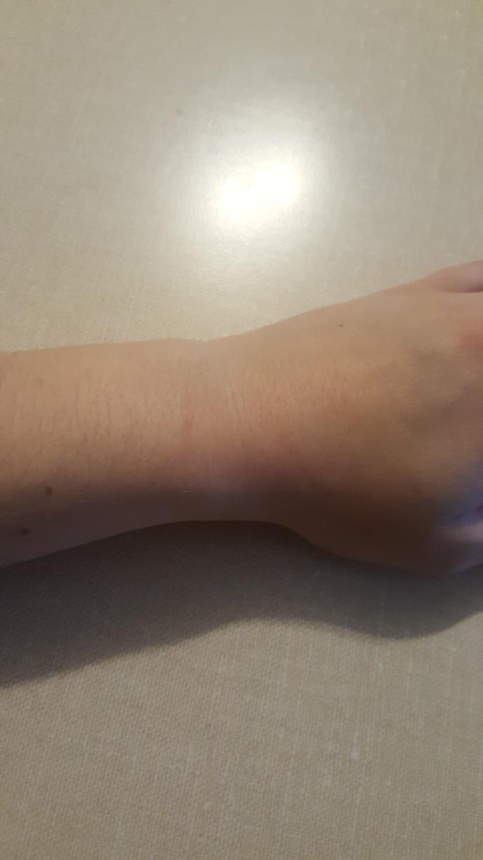 Should I get wrist surgery or is it over?