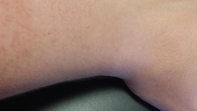 Should I get wrist surgery or is it over?