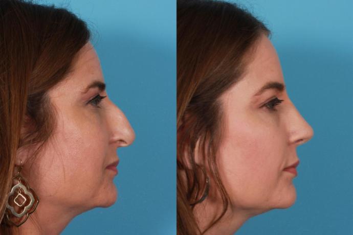 What is your opinion on rhinoplasty (nose job)?
