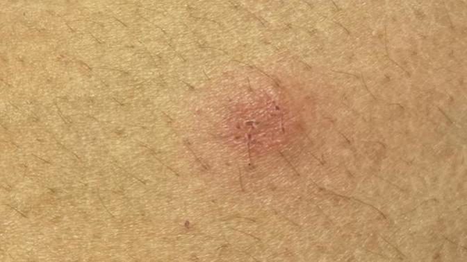 Anyone mind telling me what kind of bite this is?