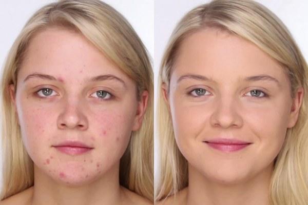 Do you get acne? & If so, do you wear makeup to conceal it?