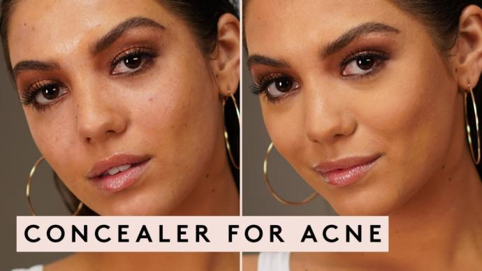 Do you get acne? & If so, do you wear makeup to conceal it?