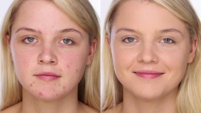 Do you get acne? & If so, do you wear makeup to conceal it?