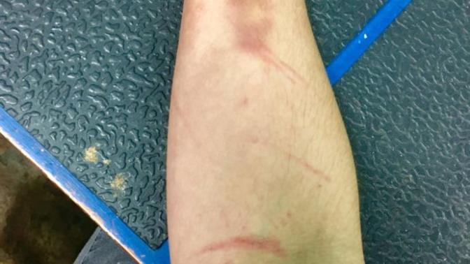 Why do I bruise so easily? Does anyone else bruise this easy?
