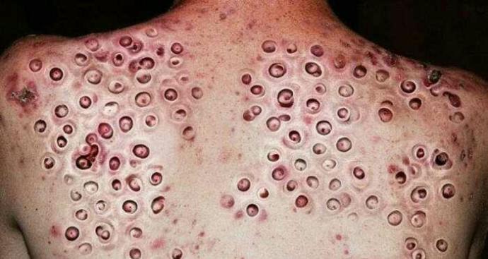 Do you have trypophobia?