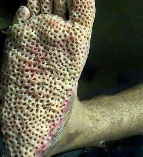 Do you have trypophobia?