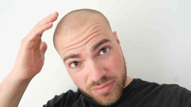 Can balding men still be attractive?