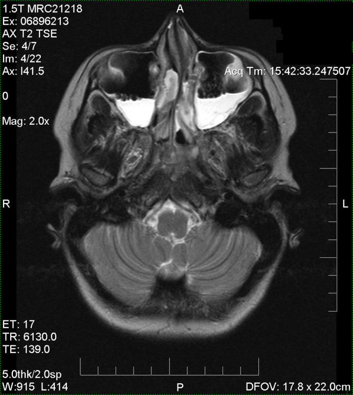 See all that white stuff? That's about 20 years of chronic pan sinusitis. It's not supposed to be there.