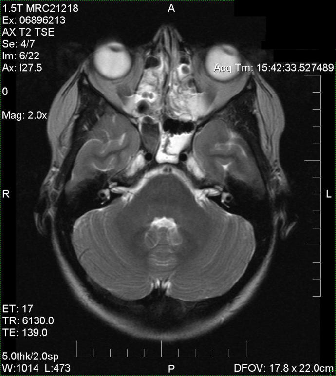 All those 'holes' in the nose are not supposed to be there. More congestion.
