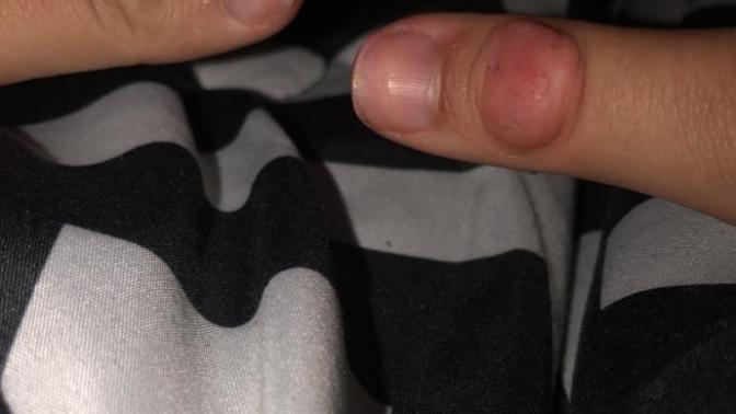 Callus on my thumbs?