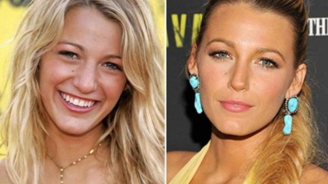 Would you negatively judge someone who had a nose job? Would you negatively judge someone who had a nose job?