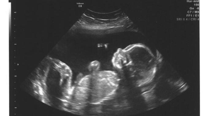 Should sexual education in schools contain video material of abortions on ultrasounds?