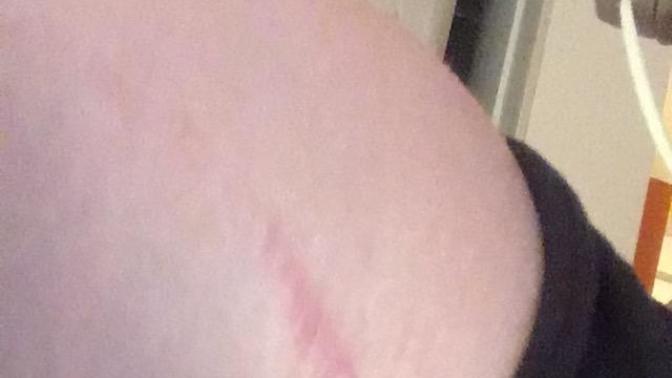 Is this a stretch mark?