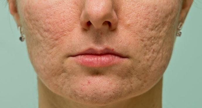 Would you date someone with acne scars?