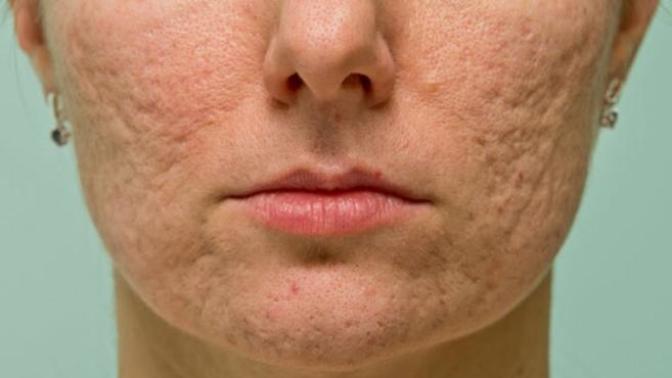 Would you date someone with acne scars?