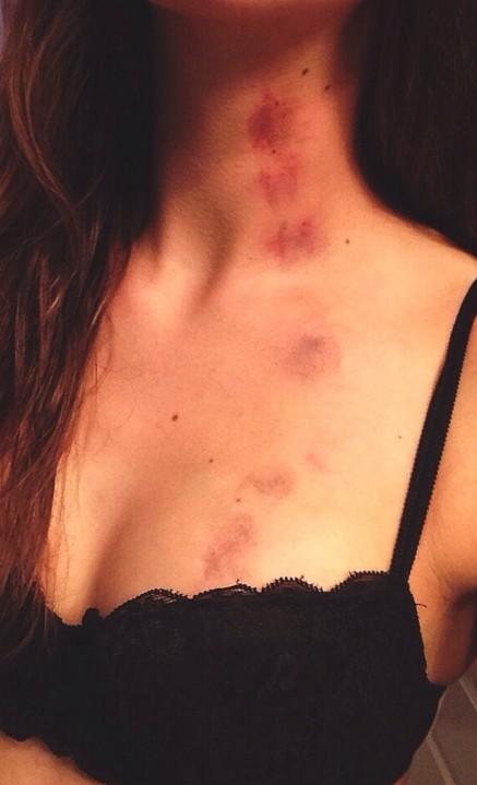 Are hickeys trashy to you?