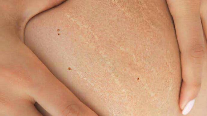 Do stretch marks and scars matter? Are they unappealing?