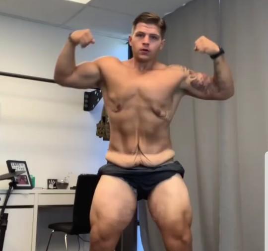 Girls, would you date a fit guy with loose skin?