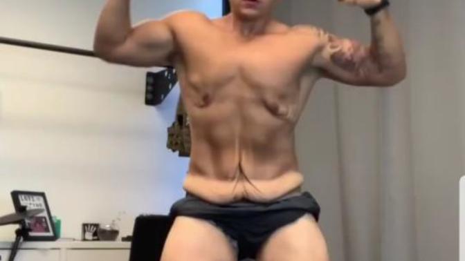 Girls, would you date a fit guy with loose skin?