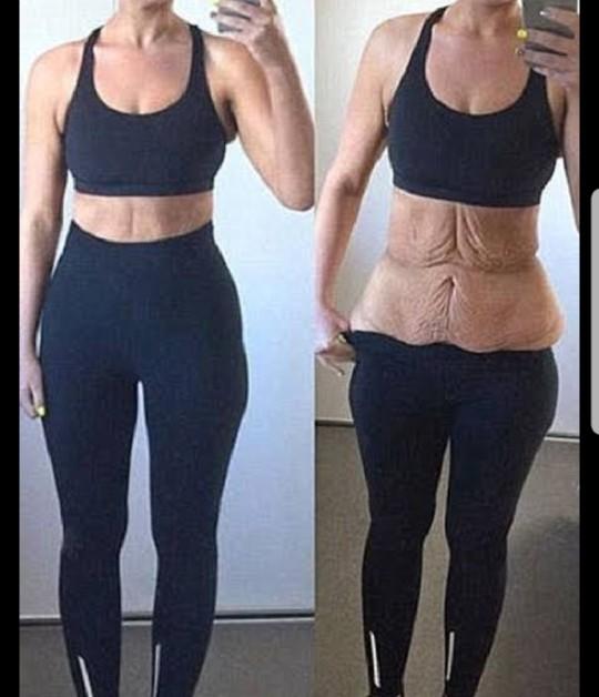Would I get loose skin if I lose 20kg/45lbs?