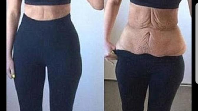 Would I get loose skin if I lose 20kg/45lbs?