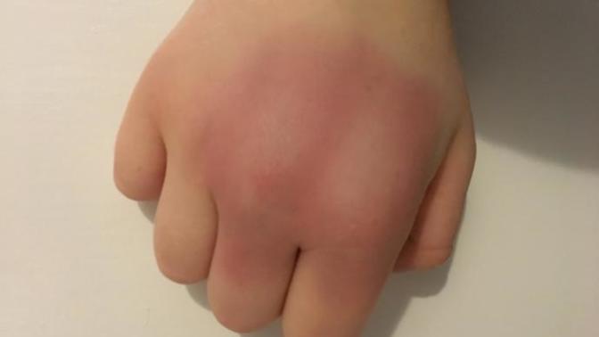 Is my knuckle broken or just bruised?