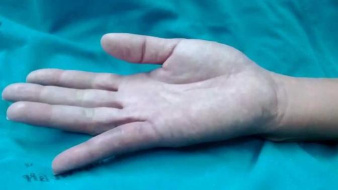 Any home remedies for a torn the ligament in my finger?