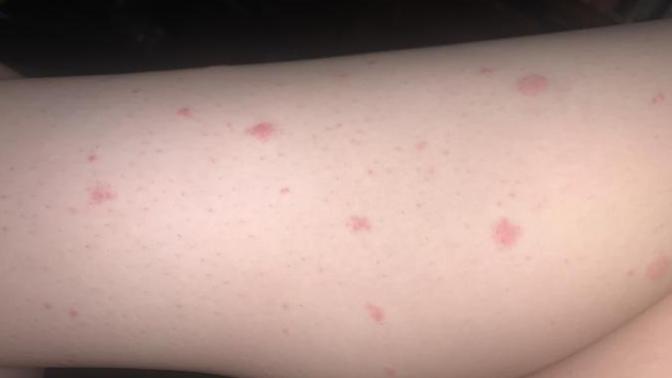 Help red spots appearing on my body?