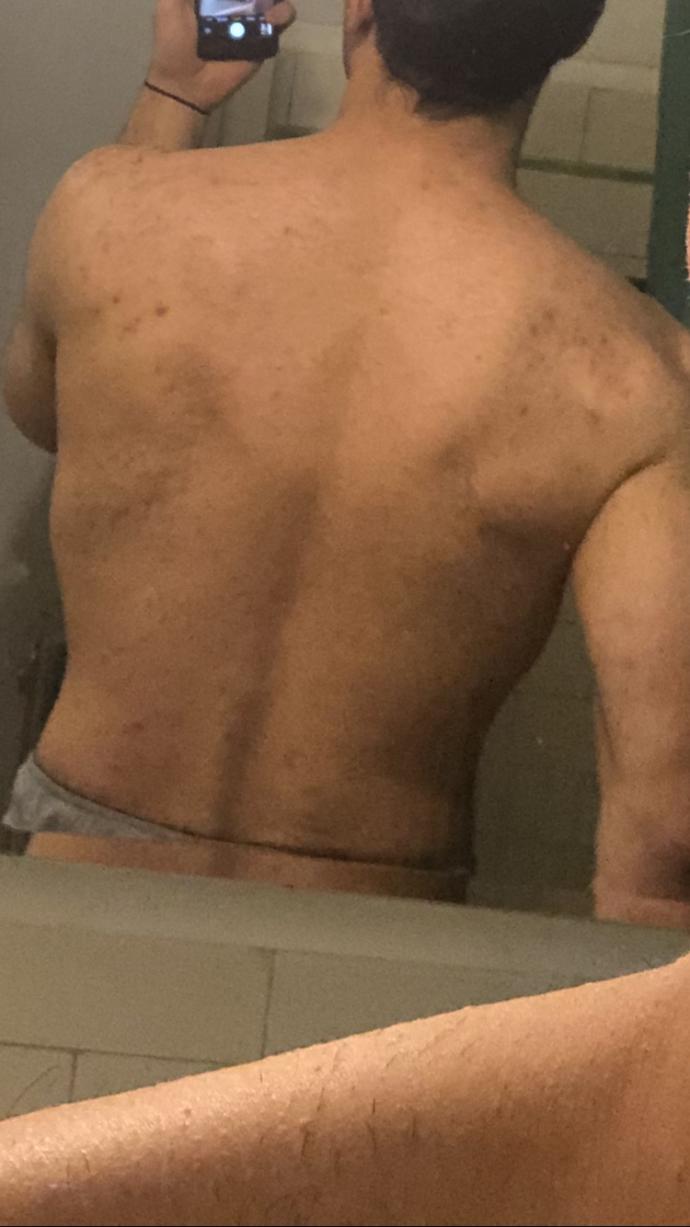 Accutane Experts Only?