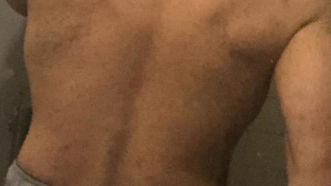 Accutane Experts Only?