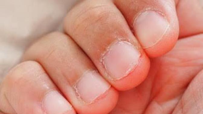 How to revive damaged fingernails?