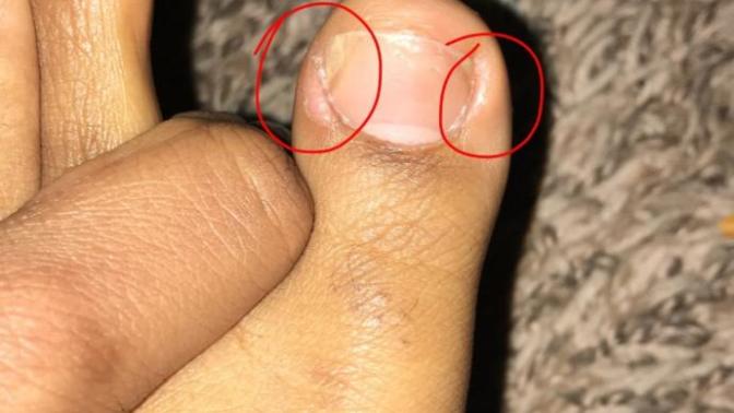 Why is my toe swollen and will it go away?