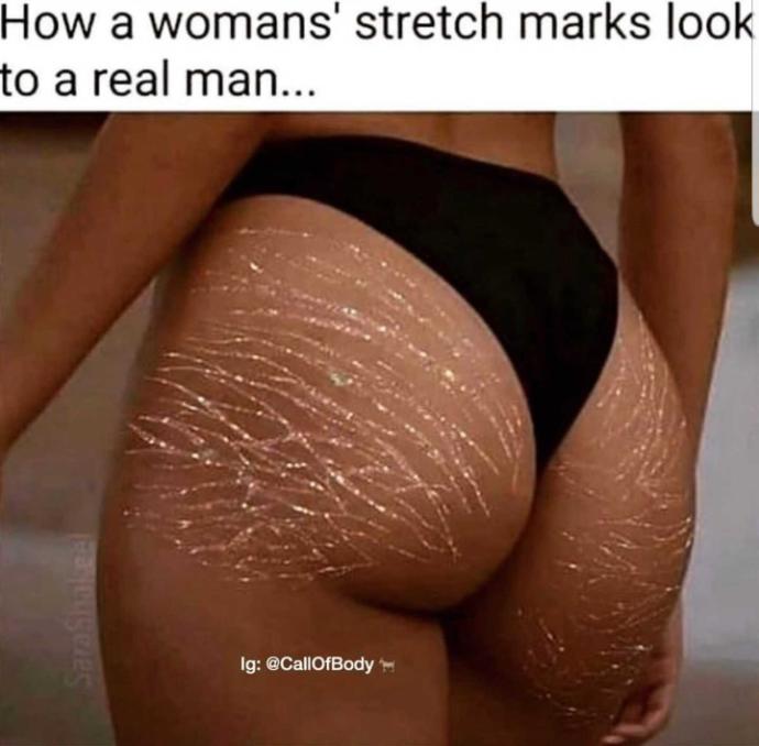 Are stretch marks a turn off for guys?