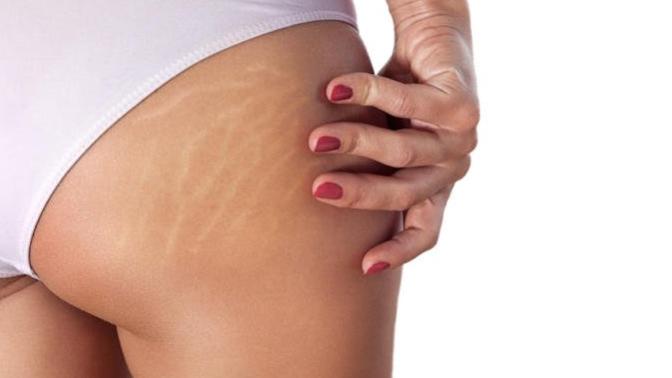 Are stretch marks a turn off for guys?