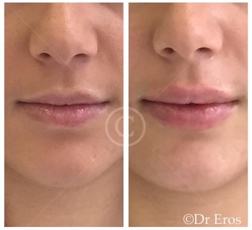 These were average and then look nicer with filler