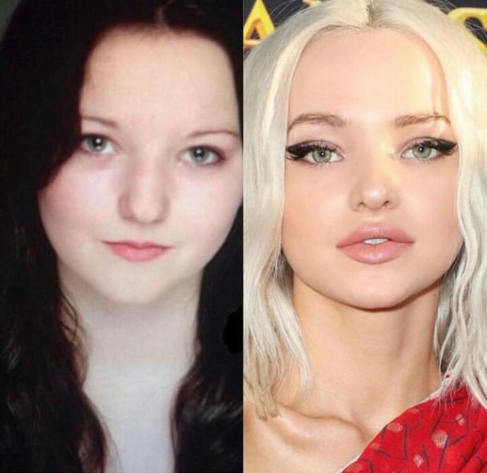 Lip fillers, guys, what do you guys really think about them? Like them? Or not? Don’t care?