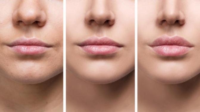Lip fillers, guys, what do you guys really think about them? Like them? Or not? Don’t care?