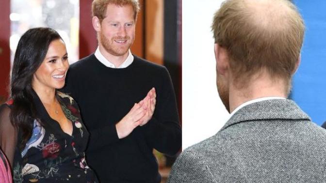 How long does it take for a man to go completely bald once he’s started losing hair from the back of his head?