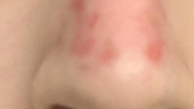 Ladies (And Gentlemen), How Can I Minimize These Burn Rashes On My Nose?