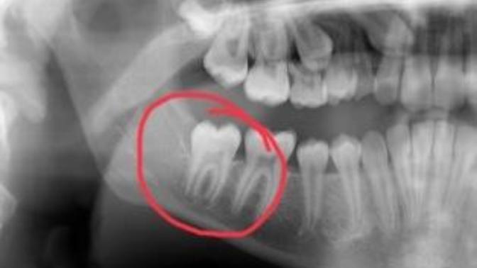 Who remembers growing their 12 year Molars?