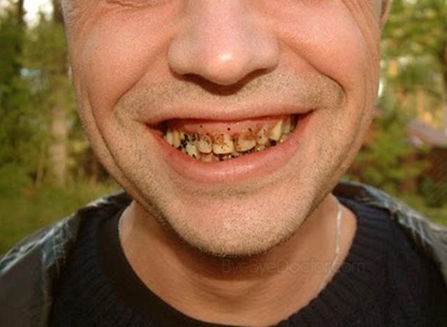 Are bad teeth a deal breaker?
