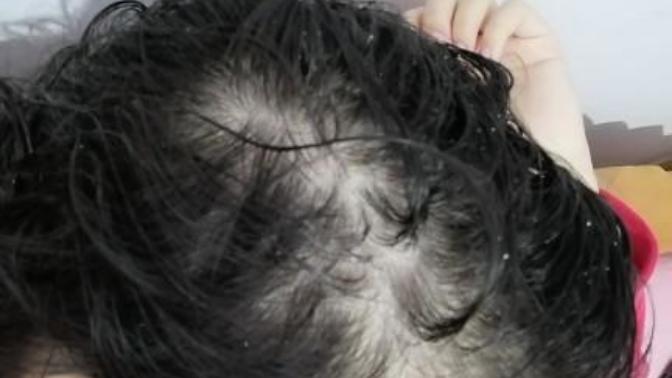 I'm going bald at 16! Pls help?