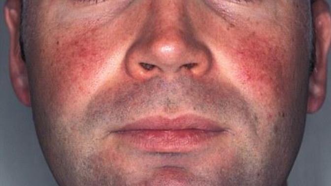 Sun Damaged Skin: Deal breaker or not?