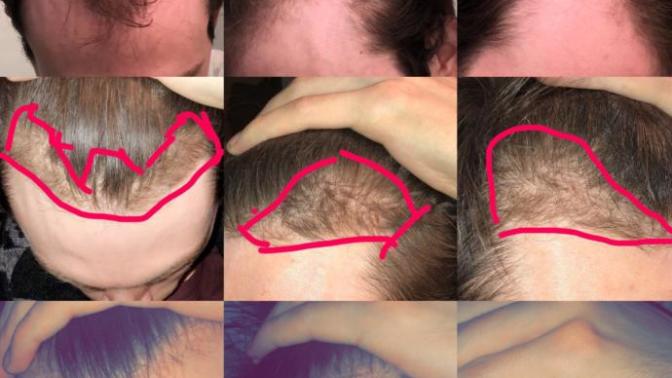 Does minoxidil stop working?