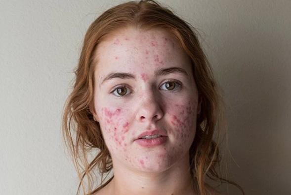 How much acne on a girl would be a dealbreaker?