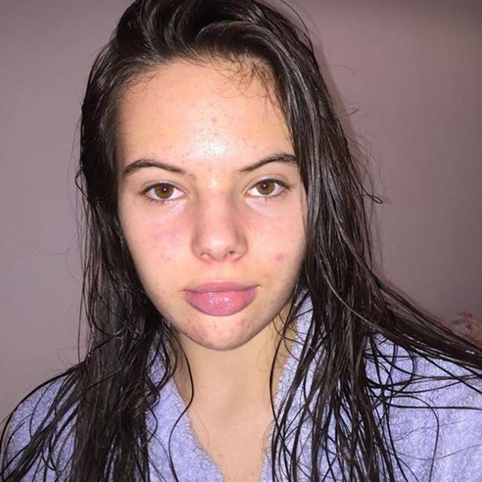 How much acne on a girl would be a dealbreaker?