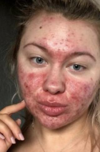 How much acne on a girl would be a dealbreaker?
