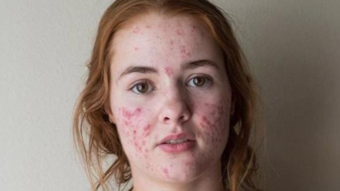How much acne on a girl would be a "dealbreaker"?