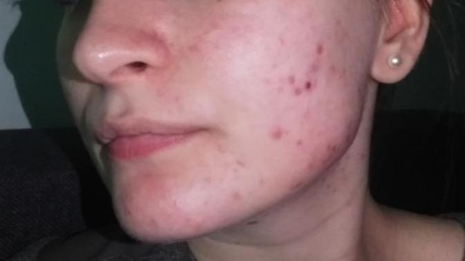 Do you think that girls with acne should never go out in public without makeup?