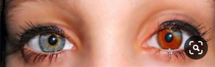 Do you have heterochromia?
